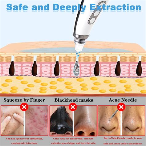 blackhead videos 2023 2