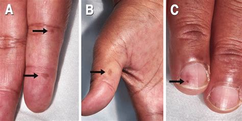 janeway lesions  splinter haemorrhages  scientific