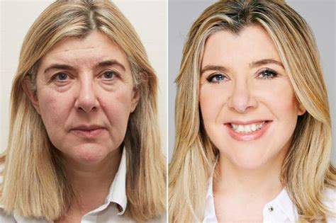 facelift surgery  thailand plastic surgery contact