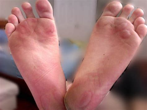 Athlete's Foot Blisters On Soles Of Feet Deals | emergencydentistry.com