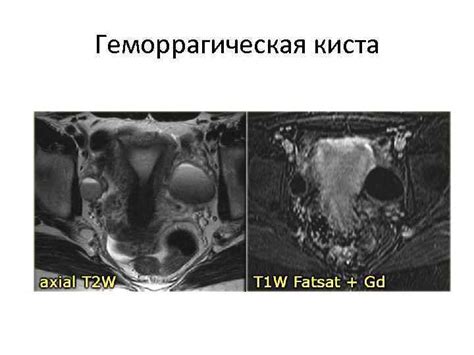 МРТ органов женского малого таза.