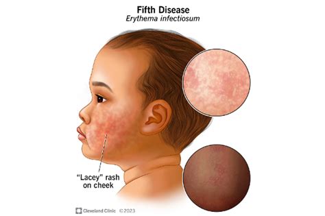 ‘Slapped cheek’ rash-causing virus on the rise among kids, CDC warns