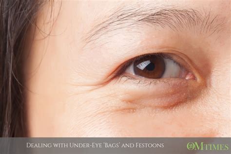 Dealing with Under-Eye ‘Bags’ and Festoons - OMTimes Magazine