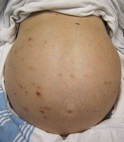 Abdominal Distension (Bloated Belly or Tummy) Causes - Healthhype