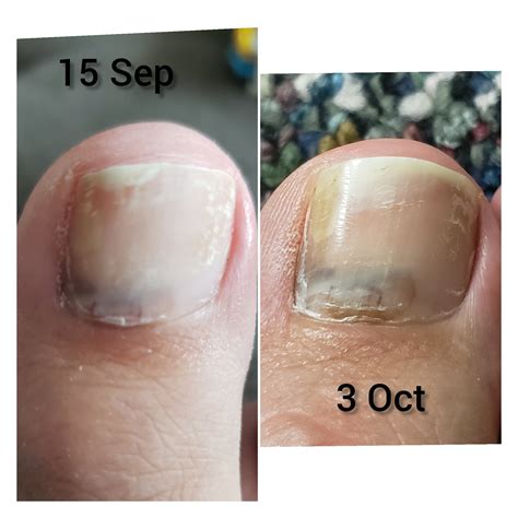 Is this toenail melanoma? : r/Dermatology