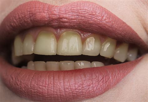 Why Are My Teeth Yellow Even Though I Brush Them Everyday? - O2 Dental