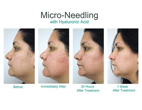 chemical face peel before and after 7