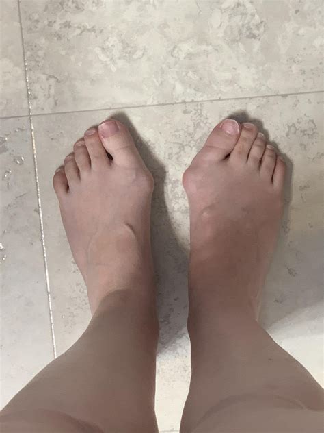 25F with severe bunions, they started developing when I was 6. They