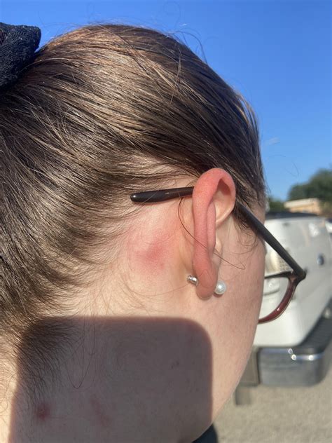 Understanding The Common Causes Of A Posterior Auricular Lymph Node Swollen One Side And When To See Doctors 4