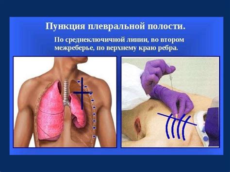 Спонтанный пневмоторакс - презентация онлайн