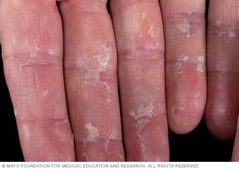 Peeling skin - Mayo Clinic