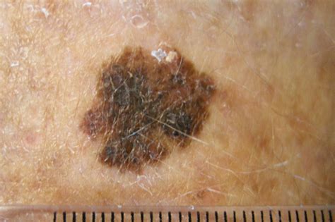 nodular malignant melanoma skin lesions
