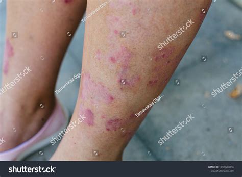 4,286 Leg rash Images, Stock Photos & Vectors | Shutterstock