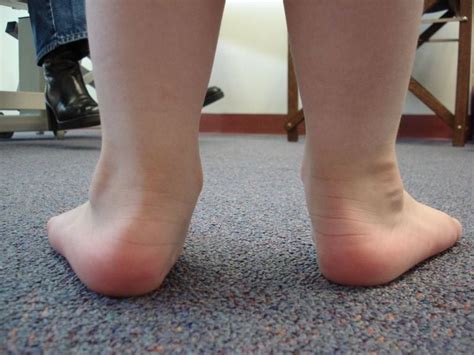 flat feet st catharines ontario canadian foot clinic orthotic centre