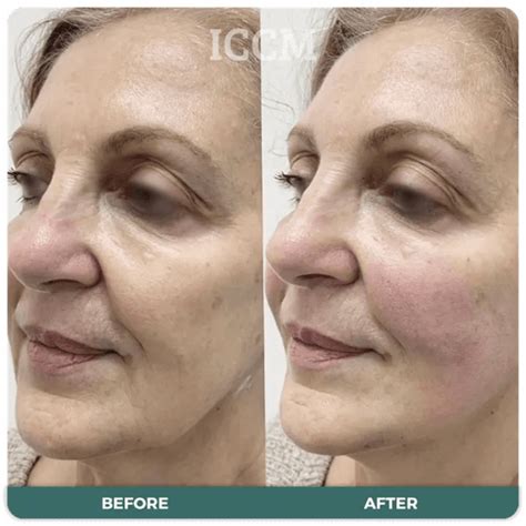 Thread Lift Recovery Time: What to Expect