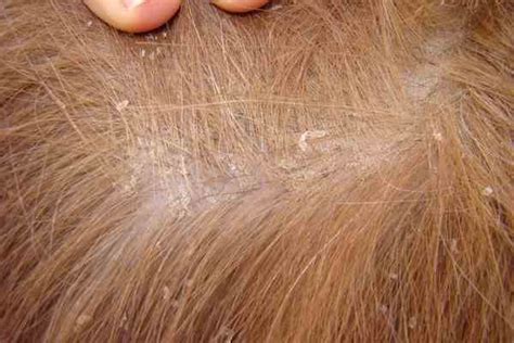 How to Get Rid of Dog Dandruff