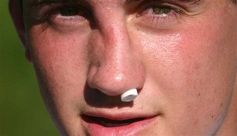 broken nose symptoms treatment