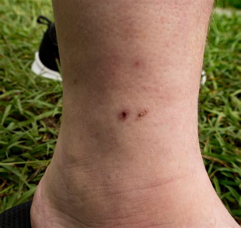 rattlesnake bite marks