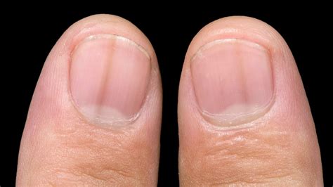 What Causes Toenail Discoloration at Hillary Bates blog