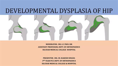 ddh developmental dysplasia  hippptx