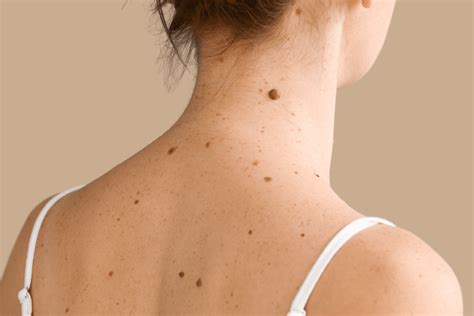 Mole/Lesion Removal - Niumee