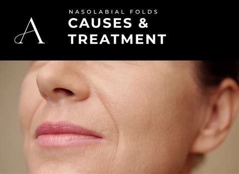 botox injection sites face      aesthetics