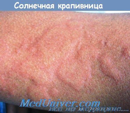Как выглядит крапивница у грудничка фото