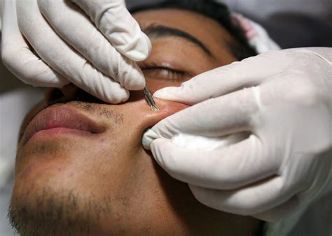 types  pimples      skin