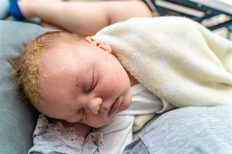 Viral Rash Toddler
