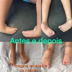 Pé Torto Congênito Antes E Depois - O Dia Mundial do Pé Torto, 3 de junho, visa chamar a atenção da ...