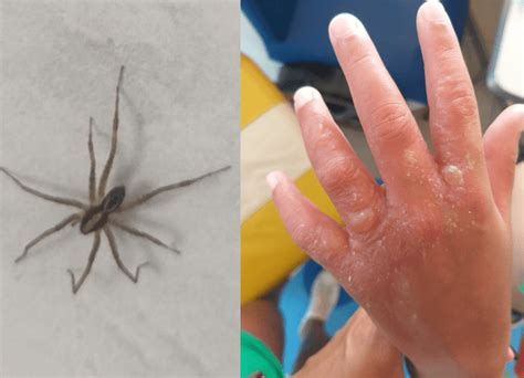 Picadas De Aranha Armadeira - Criança sofre picada de aranha-armadeira em Armação, Penha - Penha ...