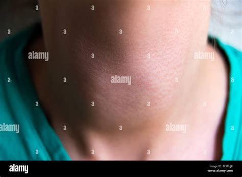 swollen neck thyroid