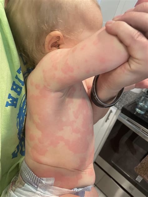 Peanut Allergy Reaction