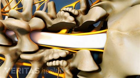 A Visual Guide to Lumbar Laminectomy Surgery