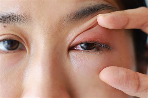 red eyes care  prevention  peachtree city eyecare