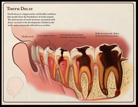 What To Do For Cavity Pain - Cares Healthy