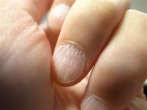 Estrías en las uñas, causas y soluciones