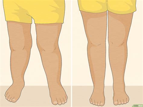 how to fix knocked knees