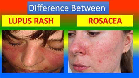 Rosacea Vs Lupus Butterfly Rash