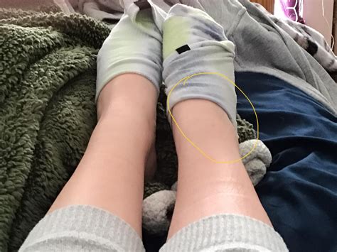 Does it look swollen? : r/Orthopedics