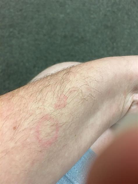 Ringworm Between Fingers