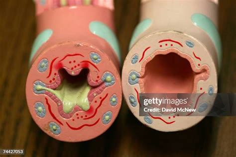 437 Inflamed Airway Stock Photos, High-Res Pictures, and Images - Getty