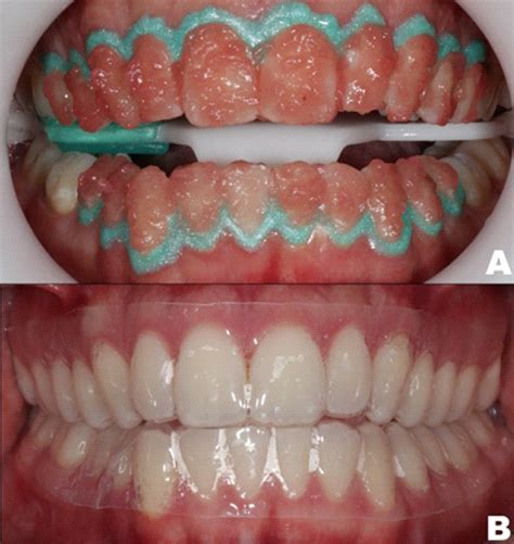 at home dental bleaching 3