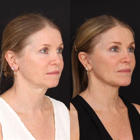 deep plane facelift    davis facial plastics