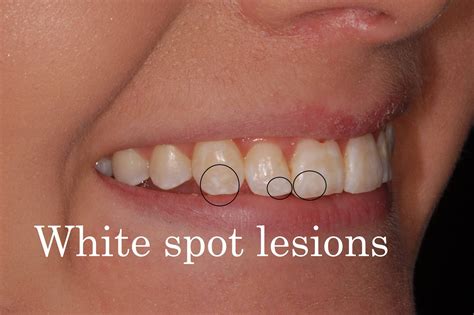 White Spots On The Teeth , What are WHITE SPOTS on Teeth Telling YOU