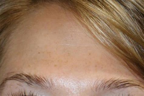 Cosmetic Injectables Archives | Brisbane Skin, Dermatologist Brisbane ...