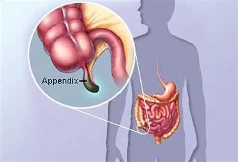 Appendicitis: Early Symptoms, Causes, Treatment, Surgery