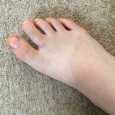 The broken toe and the drama performance - Mum of Three World