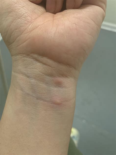 BB or carpet beetles?? 😩 : r/Bedbugs