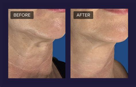 rf microneedling cost realself